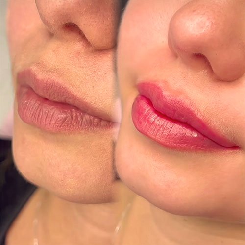 revitalizacao-labial-curitiba